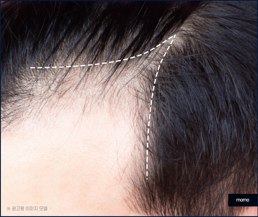 모발이식잘하는곳 찾는 결정적인 기준 관련 이미지 5