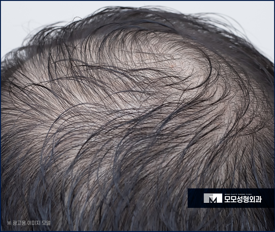 모발이식절개비절개 방식의 차이점 관련 이미지 2