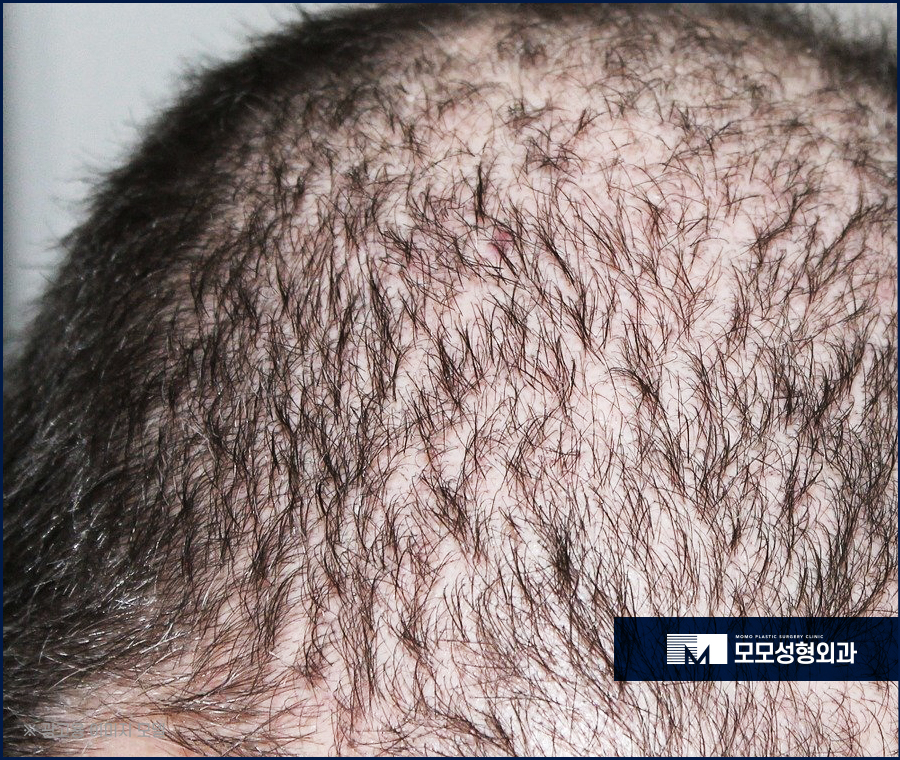 모발이식 주의사항과 꼼꼼히 숙지해야 하는 이유 관련 이미지 4