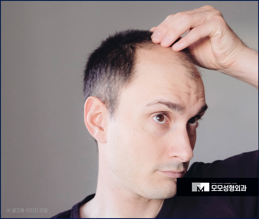 비절개모발이식비용 어느 정도 차이가 날까 관련 이미지 3