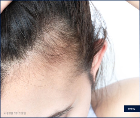 여자 m자 이마 헤어라인 모발이식으로 교정 관련 이미지 12