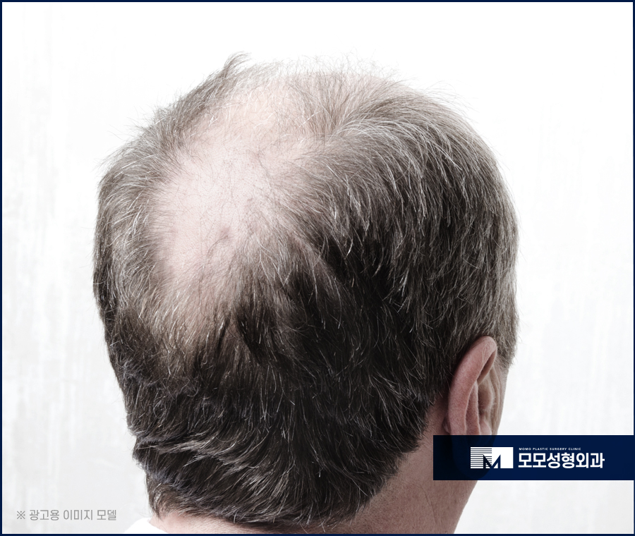 원형탈모 초기 타이밍을 놓치지 말고 대응해야 하는 이유 관련 이미지 4