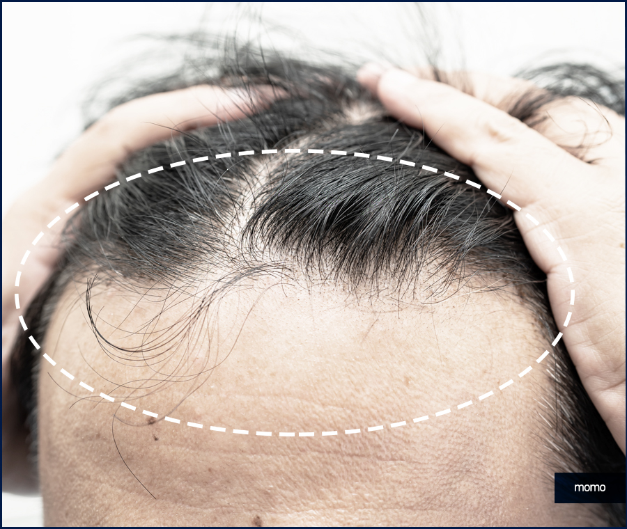 넓은이마모발이식 헤어 라인을 깔끔히 정리하는 관련 이미지 9