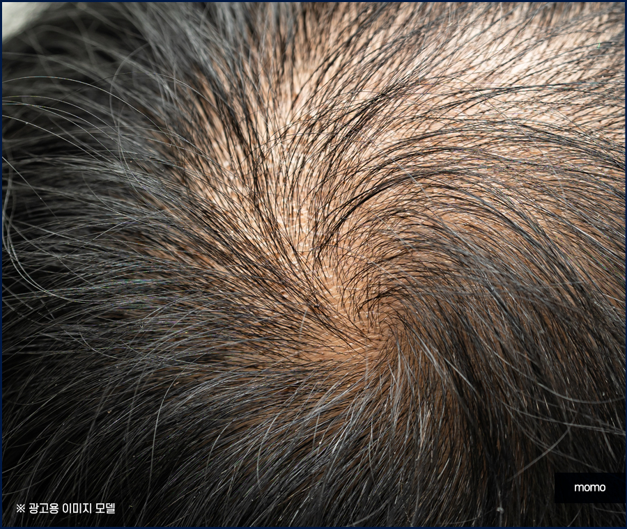 압구정 모발이식 탈모 문제를 해소하는 관련 이미지 14
