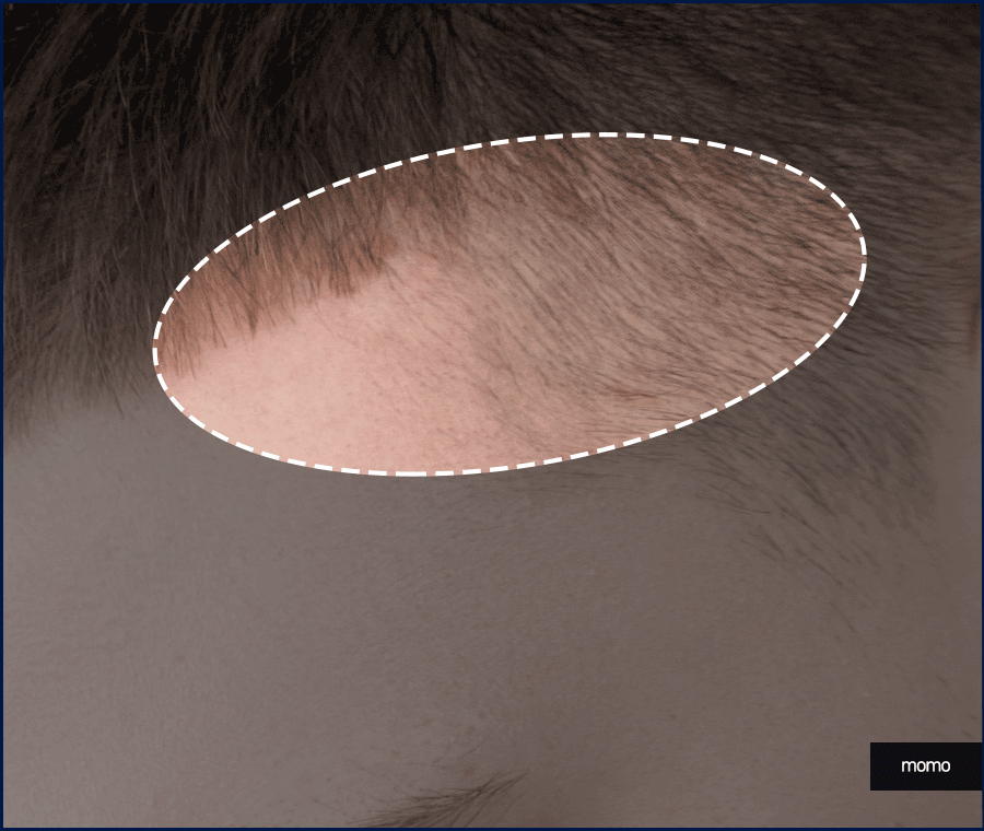 남자헤어라인모발이식 디자인의 중요성 관련 이미지 10
