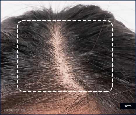 여자 정수리 탈모 모발이식 꼼꼼히 채우는 관련 이미지 5