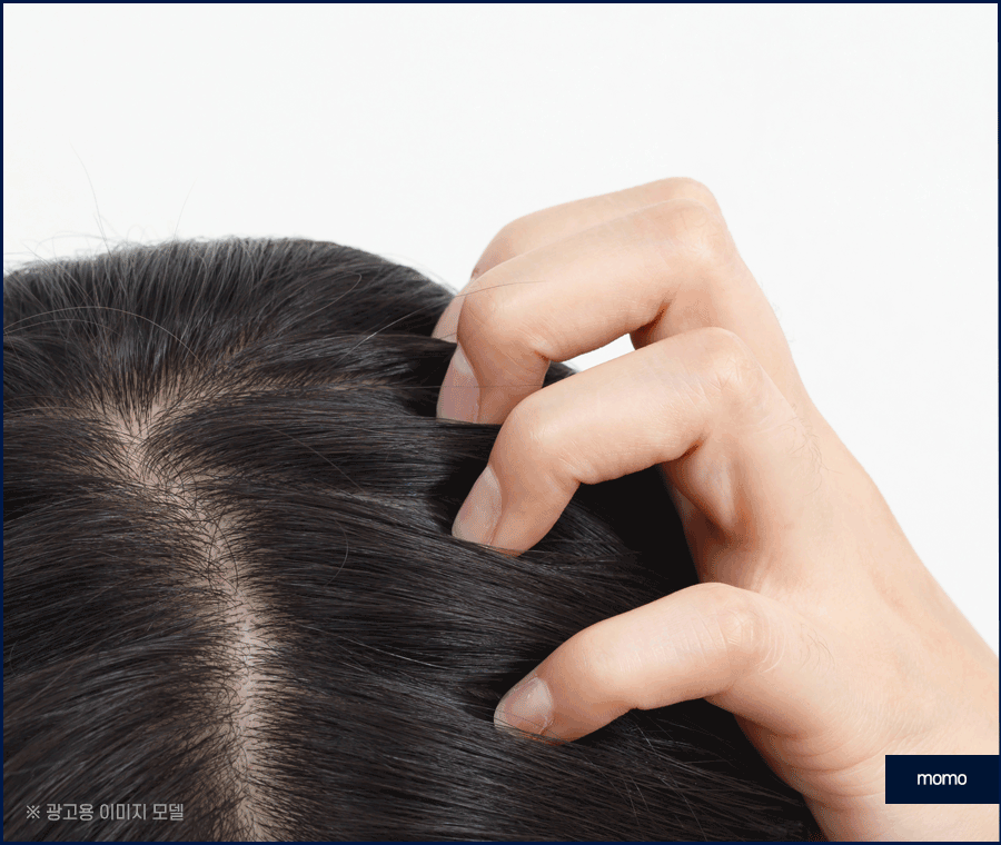 모발이식 2000모 자연스러운 커버 결과 정도는? 관련 이미지 4