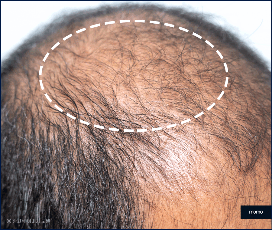 압구정모발이식 원하던 모습을 찾는 포인트 관련 이미지 3