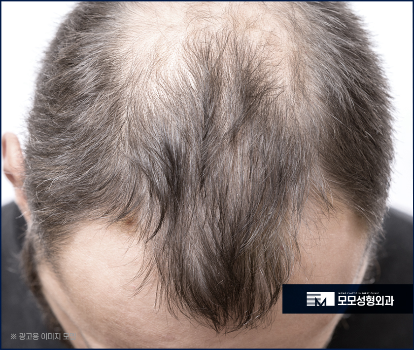 엠자이마를 그대로 두지 말아야하는 원인은 관련 이미지 2