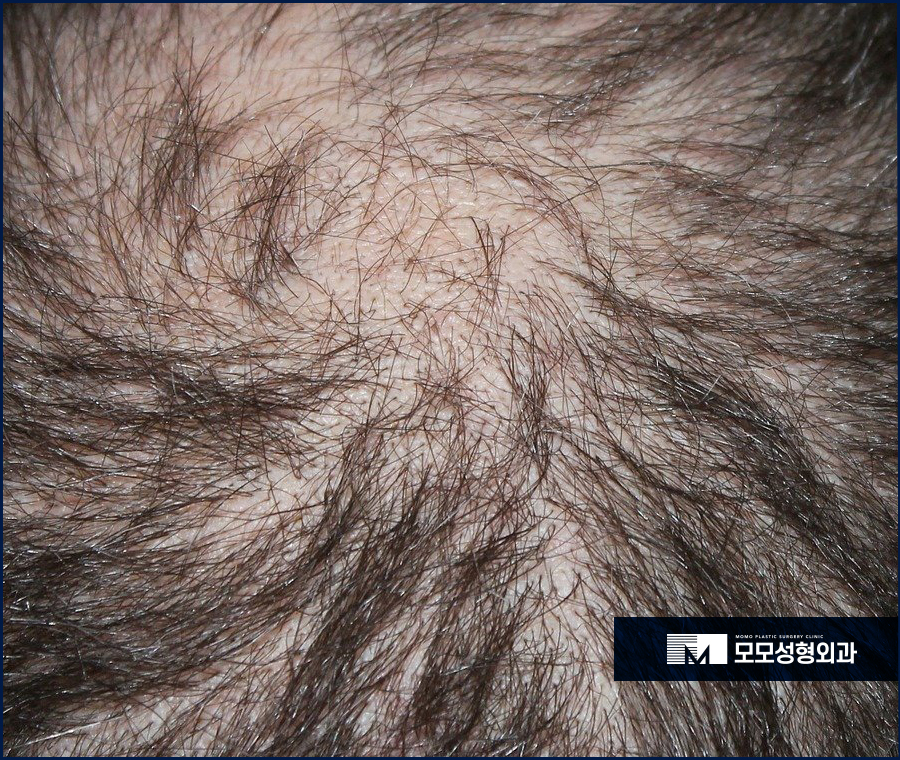 서울 모발이식 맞춤 진행으로 풍성함을 관련 이미지 3