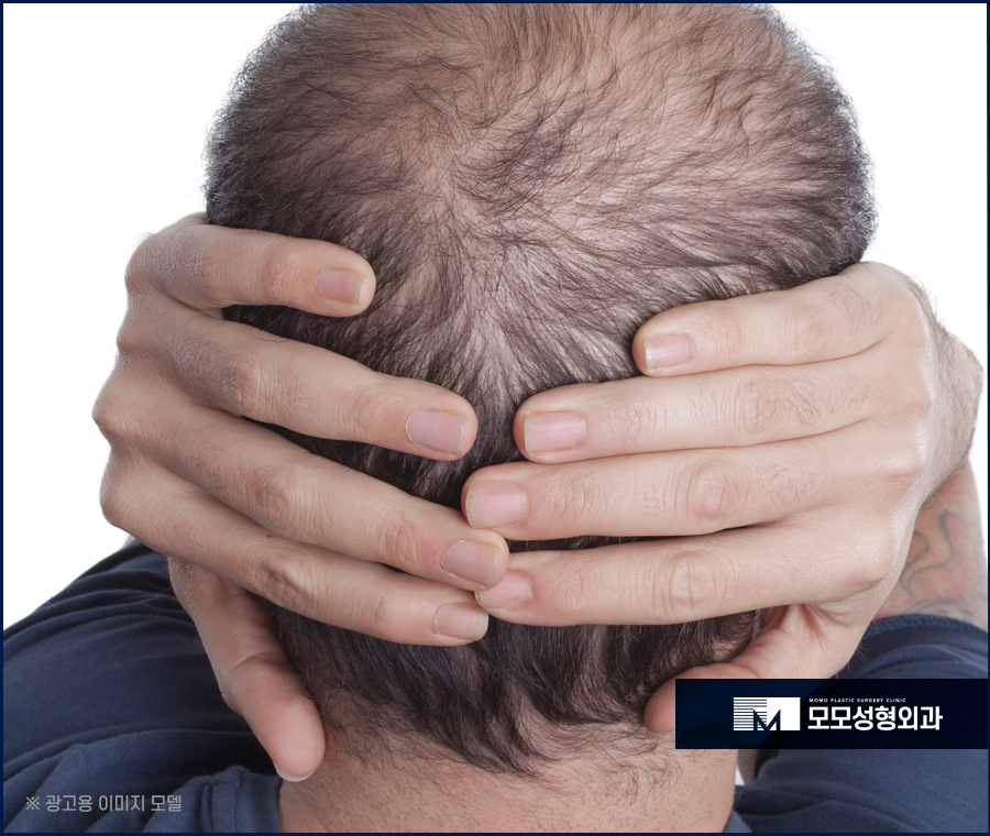 마이크로컷 비절개 모발이식 자연스러운 이후 외모를 관련 이미지 3