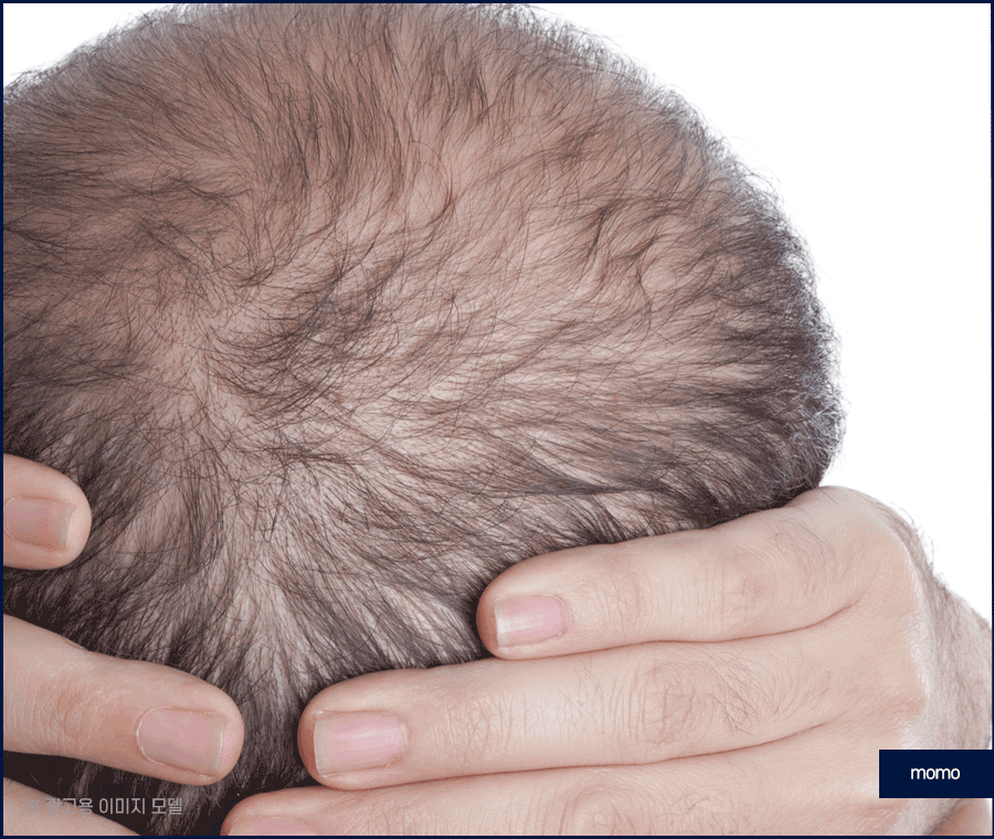 모발이식병원추천 개인에게 맞춰 진단하는 곳으로 관련 이미지 10