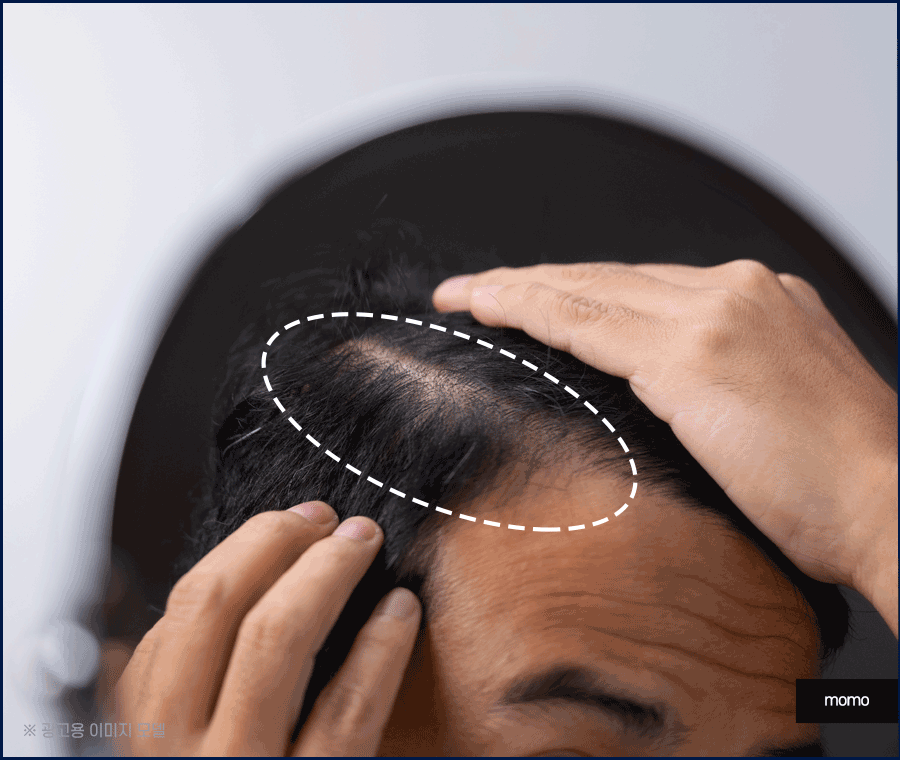 남자 모발이식 비용, 방법까지 꼼꼼히 확인하세요! 관련 이미지 4