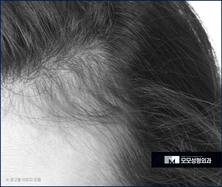 여자 옆머리 탈모 이유와 극복하고 채워가려면 관련 이미지 11