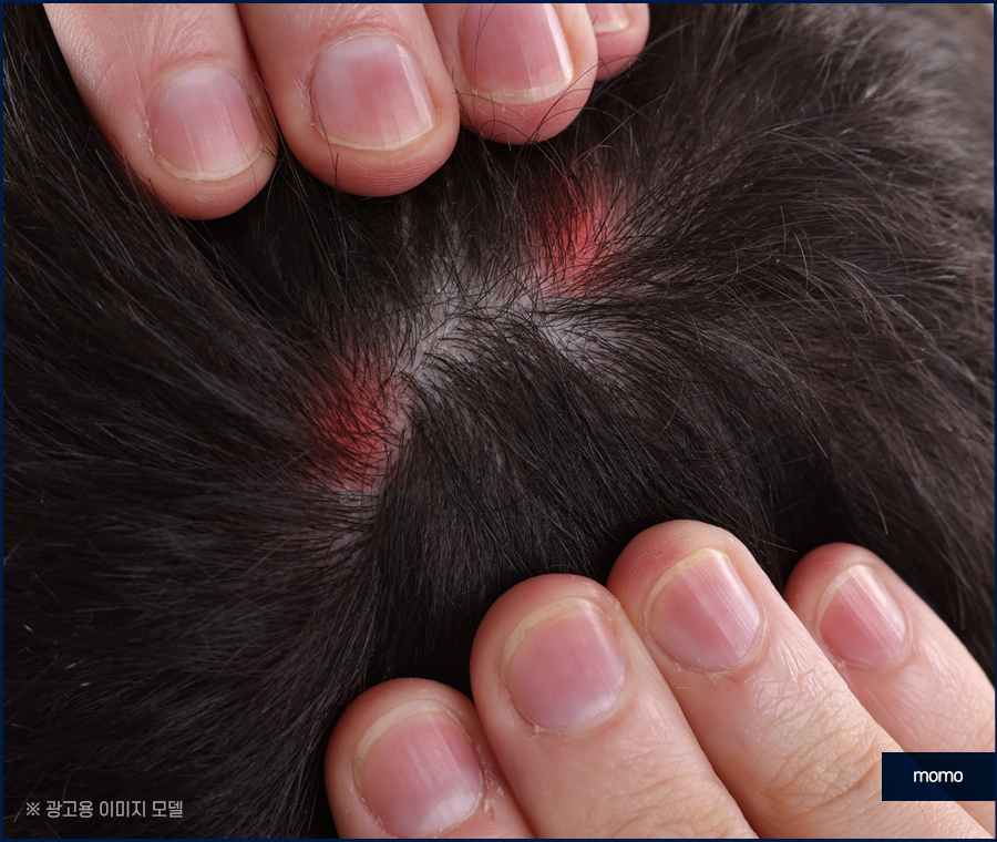 두피 종기 원인 및 치료, 관리 방법 관련 이미지 7