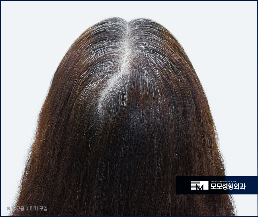 여성 옆머리 탈모 증상이 보여질 경우 해결 방법은 관련 이미지 5