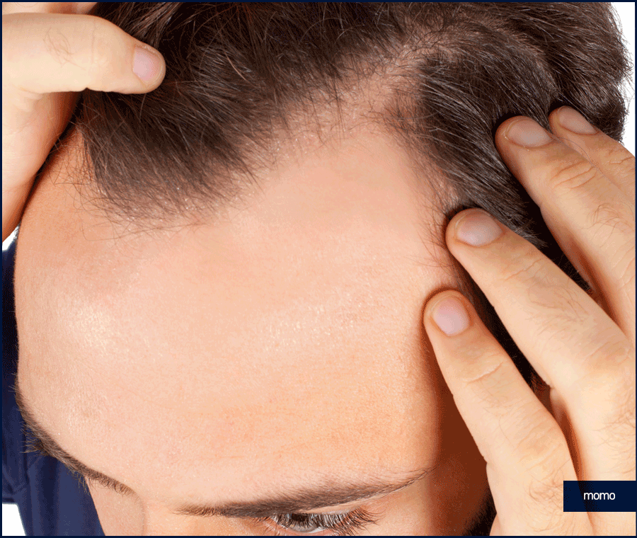 20대 탈모약 처방 및 복용 시 꼭 확인해야 할 점 관련 이미지 10