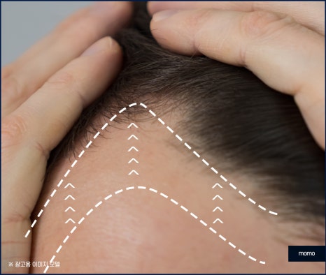 압구정 모발이식 탈모 문제를 해소하는 관련 이미지 7