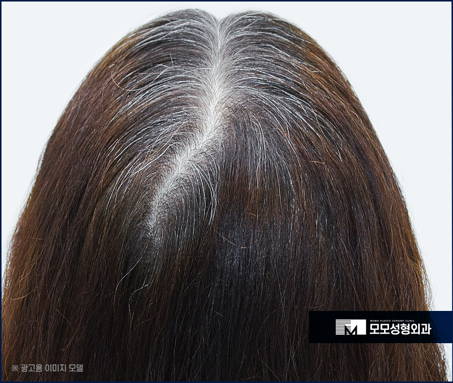 압구정모발이식 자연스러운 예후를 위한 선택 관련 이미지 4