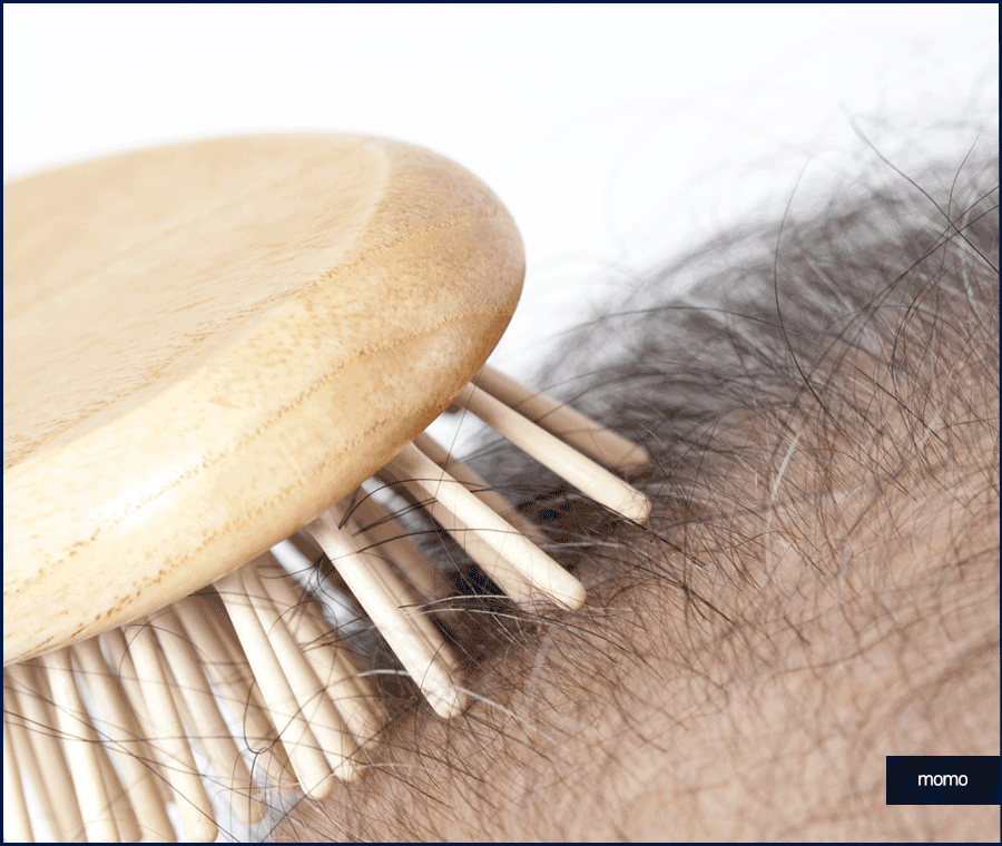 모발이식재수술 원인 및 성공을 위한 핵심 2가지 관련 이미지 3