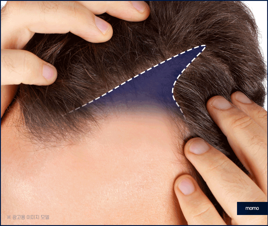 M자탈모치료 모발이식이 특별한 이유 3가지 관련 이미지 8