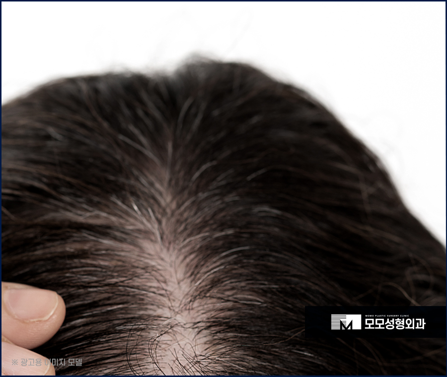 강남역 모발이식 빈 곳을 채우며 풍성하게 관련 이미지 3