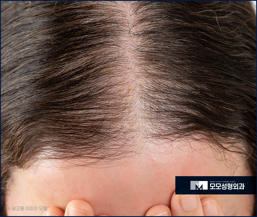 여성정수리모발이식 채워가고자 할 때에는 관련 이미지 2