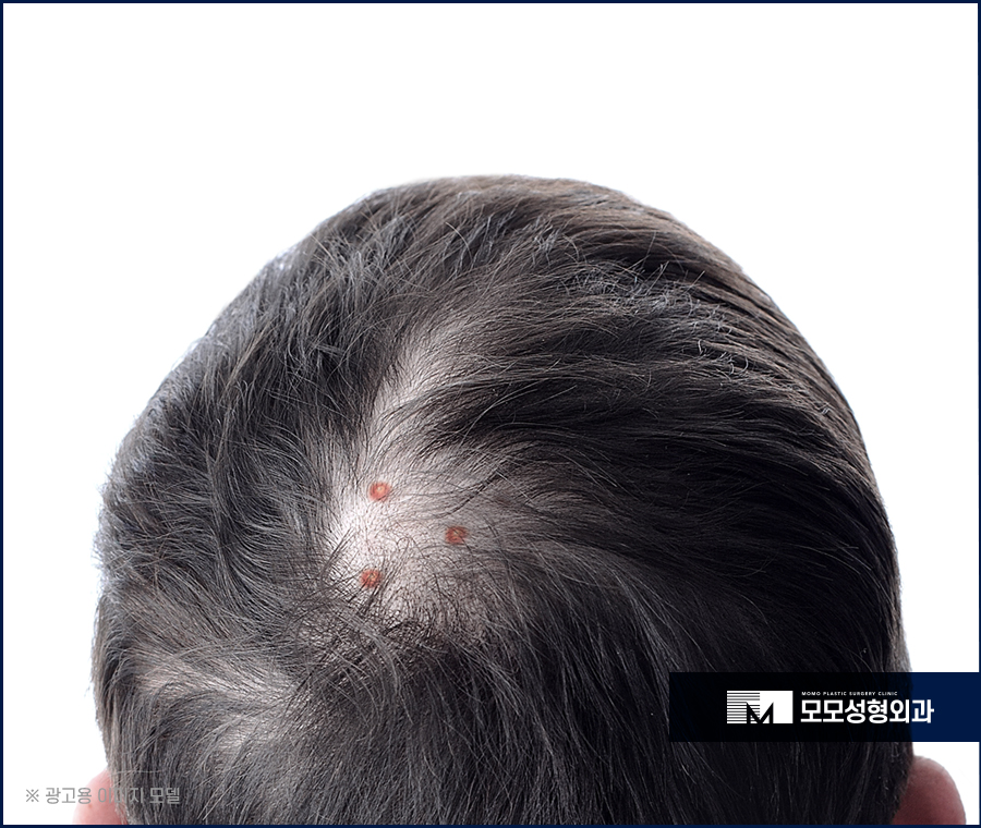 두피뾰루지원인 부터 조치하는 방법은 관련 이미지 2