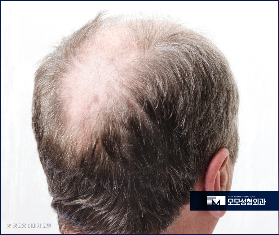 남자헤어라인교정 반듯함으로 완성하는 외모 관련 이미지 5