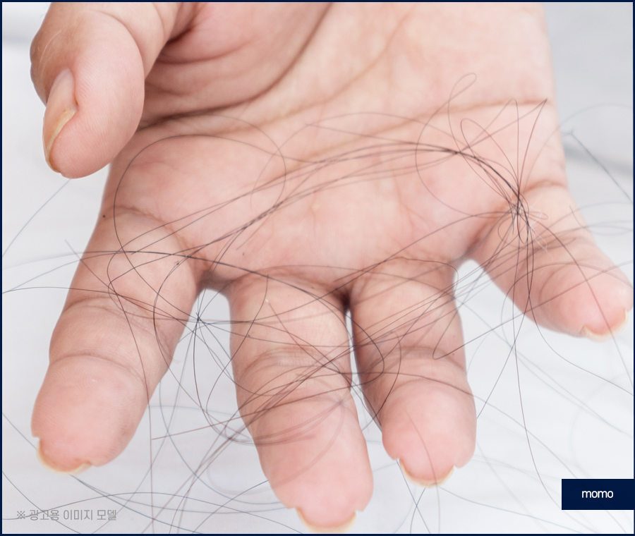 넓은이마모발이식 헤어 라인을 깔끔히 정리하는 관련 이미지 3