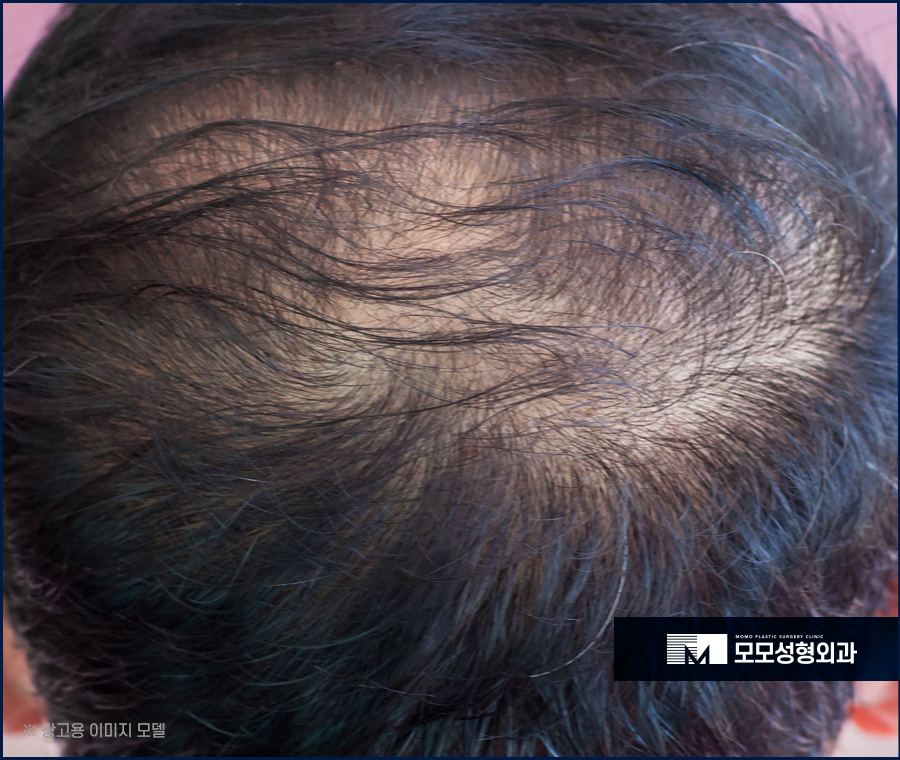 모발이식3000모비용 찾아 보는 것 보다 우선적인 것은 관련 이미지 2