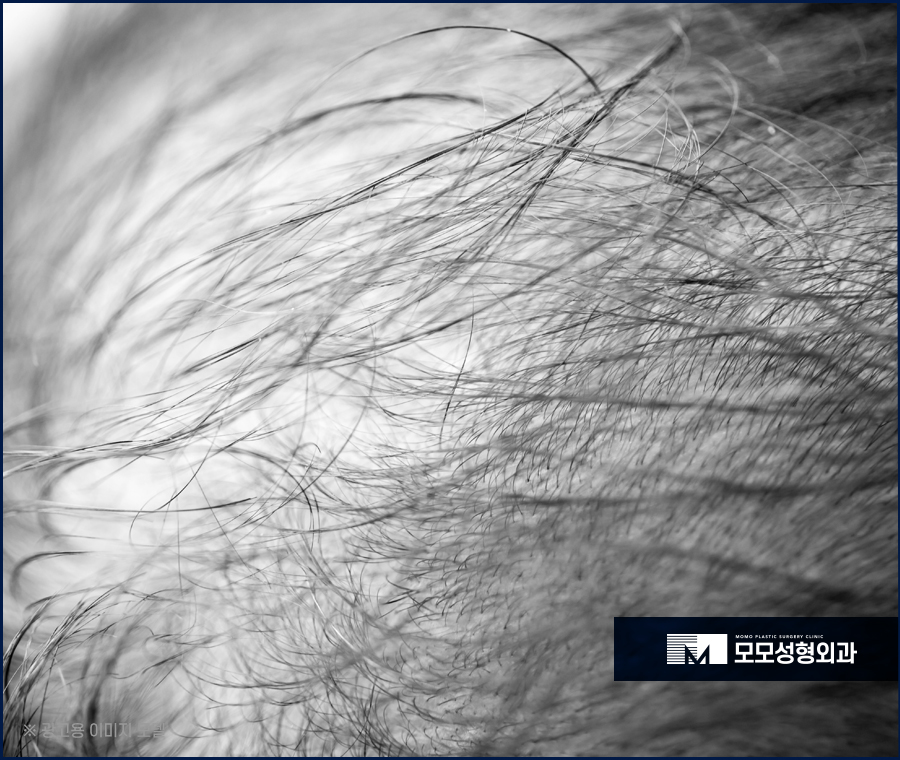 대량모발이식 부족하지 않게 채워가는 방향으로 관련 이미지 3