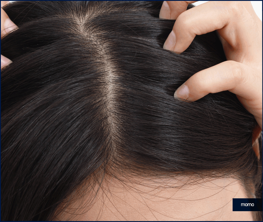 앞머리 모발이식 비용 개인에 따라 달라지는 이유 관련 이미지 2