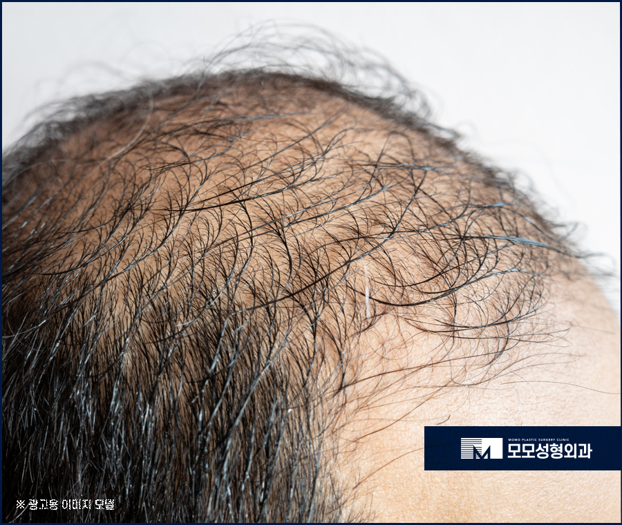 지루성두피염증상 어떤 것들이 있는지 관련 이미지 11