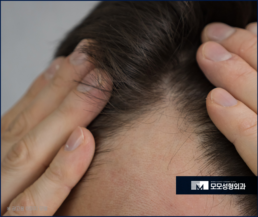 M자모발이식비용이 달라지는 기준과 방식의 차이에 대해 관련 이미지 5