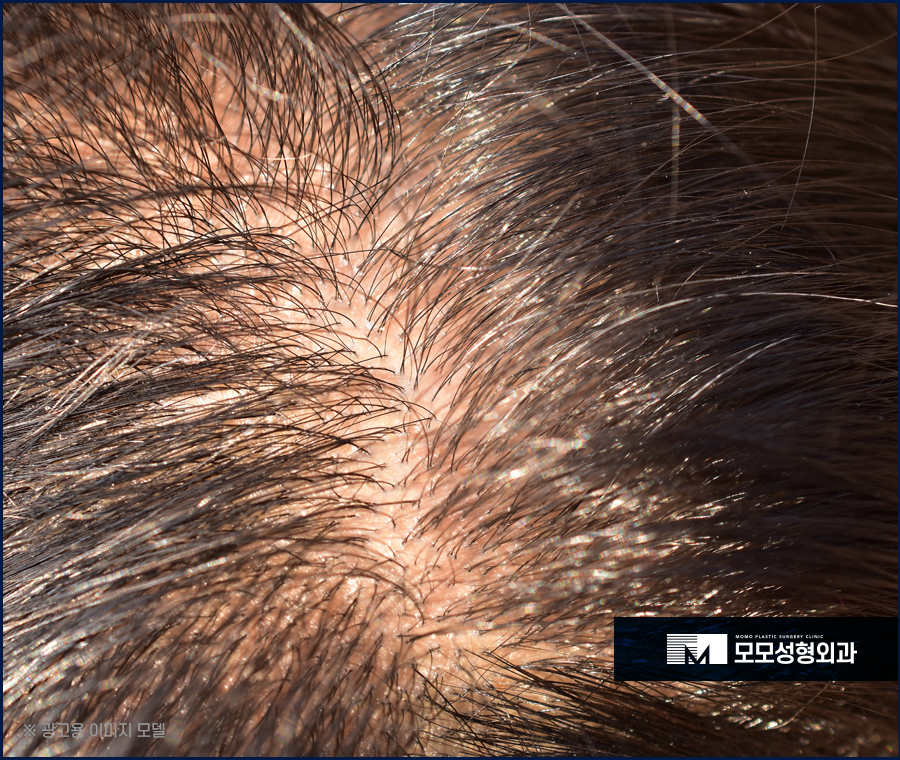 가르마모발이식 하얗게 보이던 부분을 채워서 관련 이미지 2