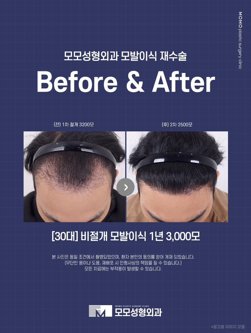 남자헤어라인모발이식 디자인까지 꼼꼼하게 고려하며 관련 이미지 10