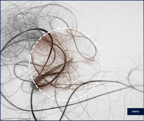 모발이식3000모비용 차이나는 이유 관련 이미지 2