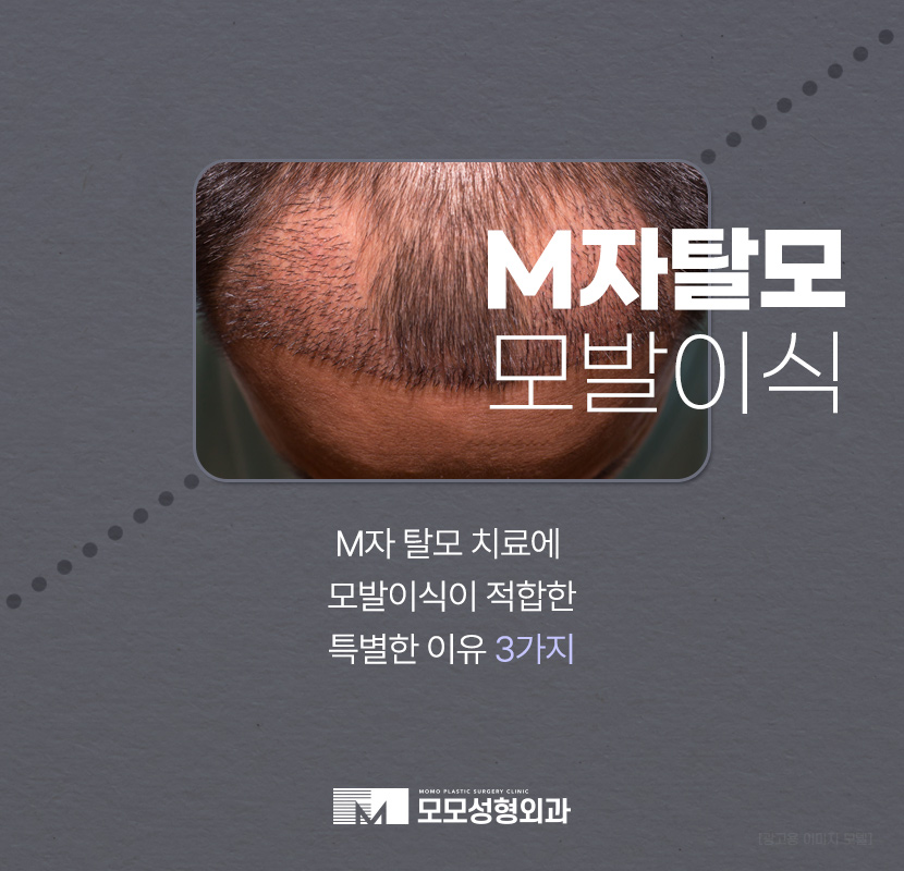 M자탈모치료 모발이식이 특별한 이유 3가지 관련 이미지 1