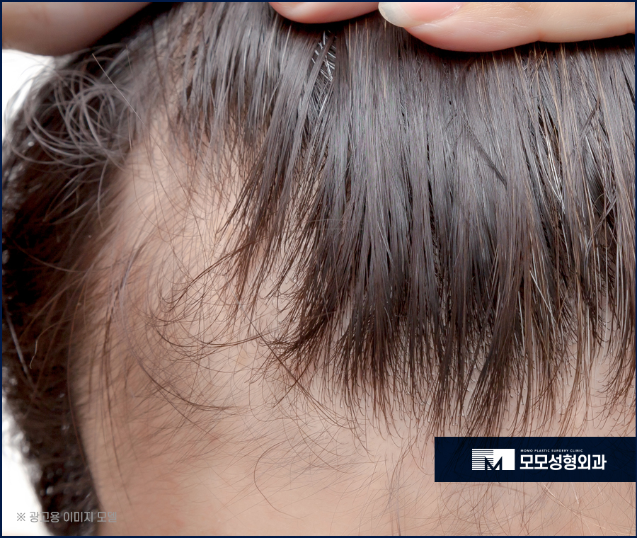 모발이식 1년이 지났을 때 경과가 좋으려면 관련 이미지 2