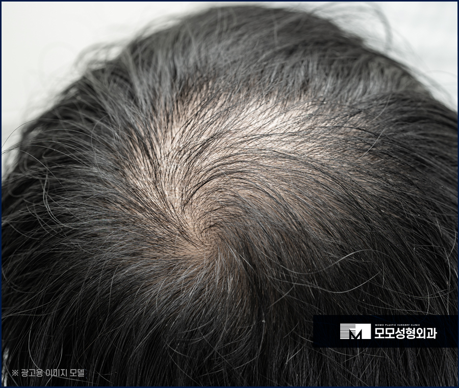 두피모낭염 증상 및 완화를 위한 방법에 대해서 관련 이미지 4
