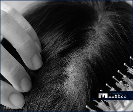 여자 옆머리 탈모 이유와 극복하고 채워가려면 관련 이미지 2