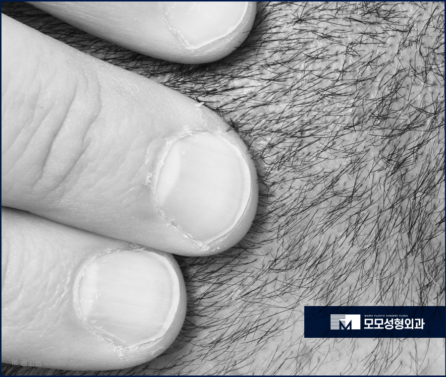 압구정 모발이식 안정적인 생착을 만드는 관련 이미지 7