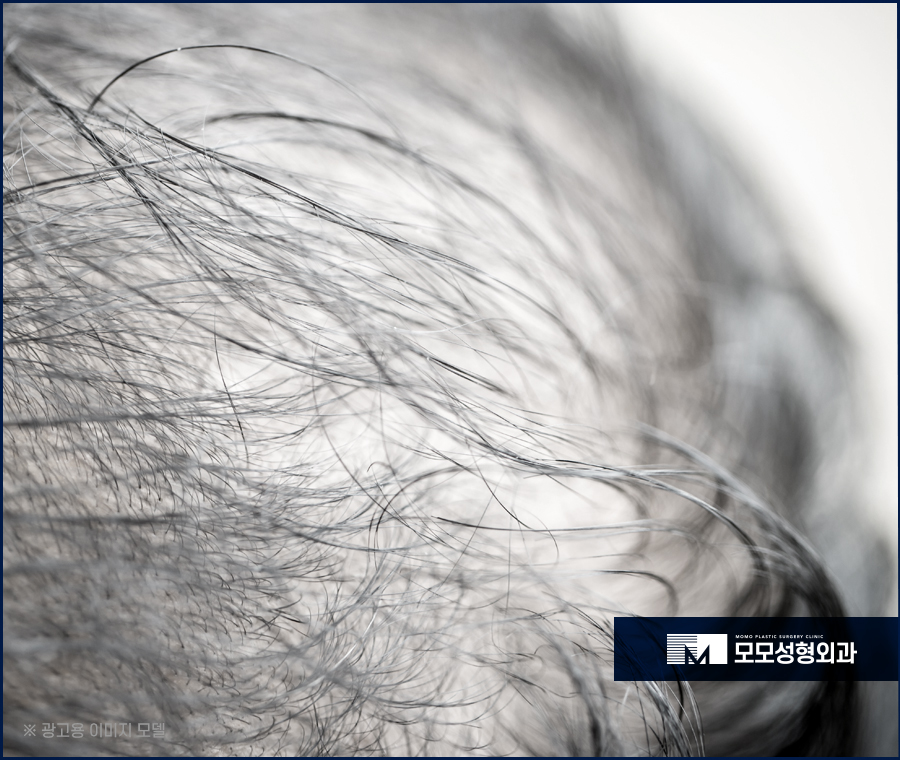 비절개모발이식가격 시작 전에 확인해 보는 관련 이미지 4