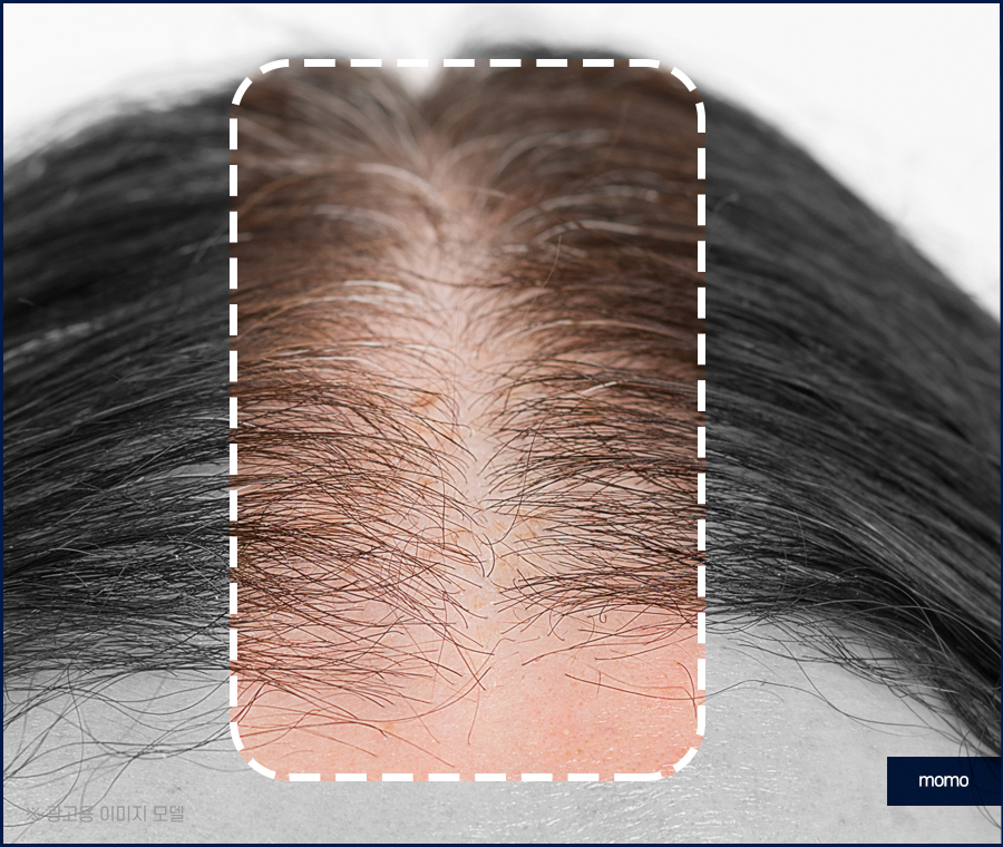 서울모발이식병원 나아지는 과정은 관련 이미지 6
