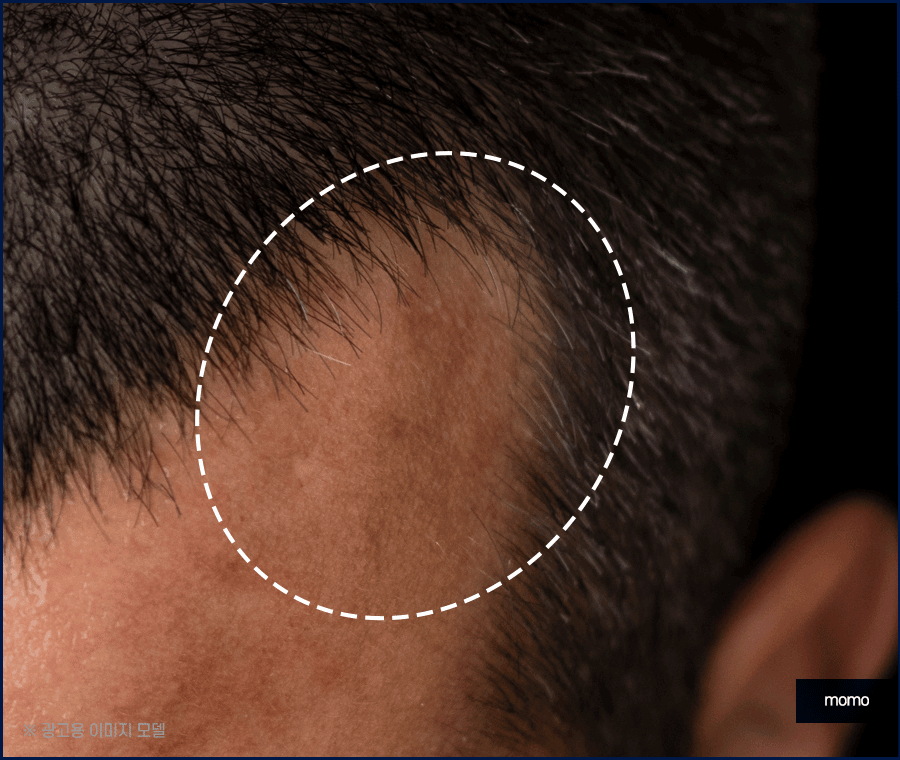 m자탈모병원 모발이식 고민이신 분들이라면 필독 관련 이미지 4