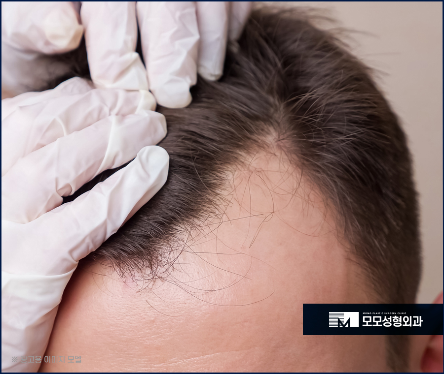 압구정모발이식 자연스러운 예후를 위한 선택 관련 이미지 3