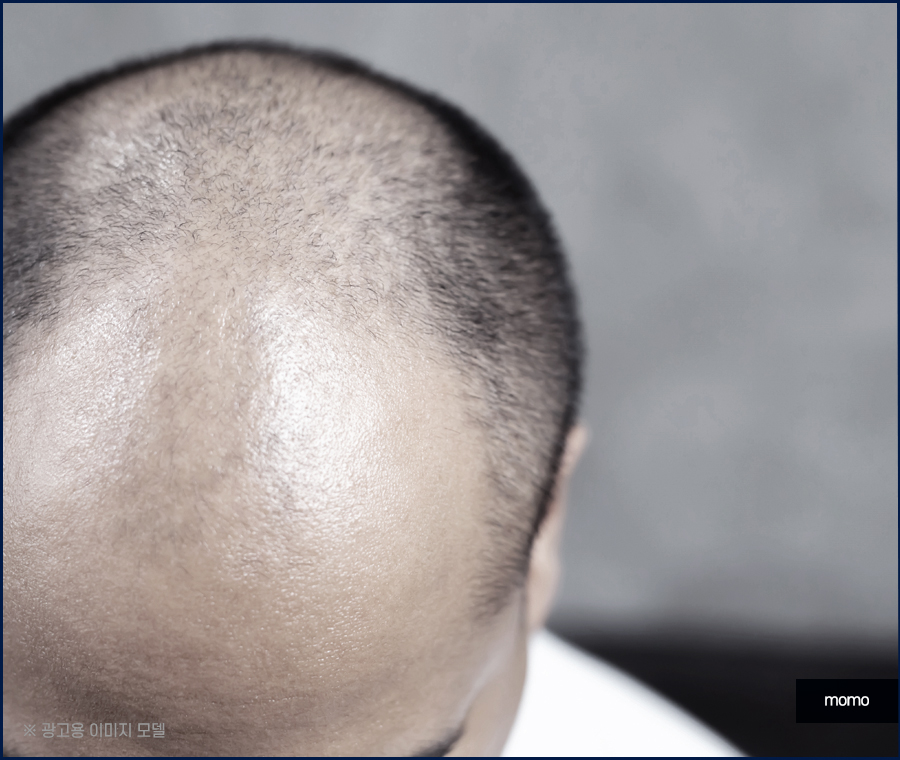 모발이식재수술 원인 파악을 먼저 관련 이미지 5