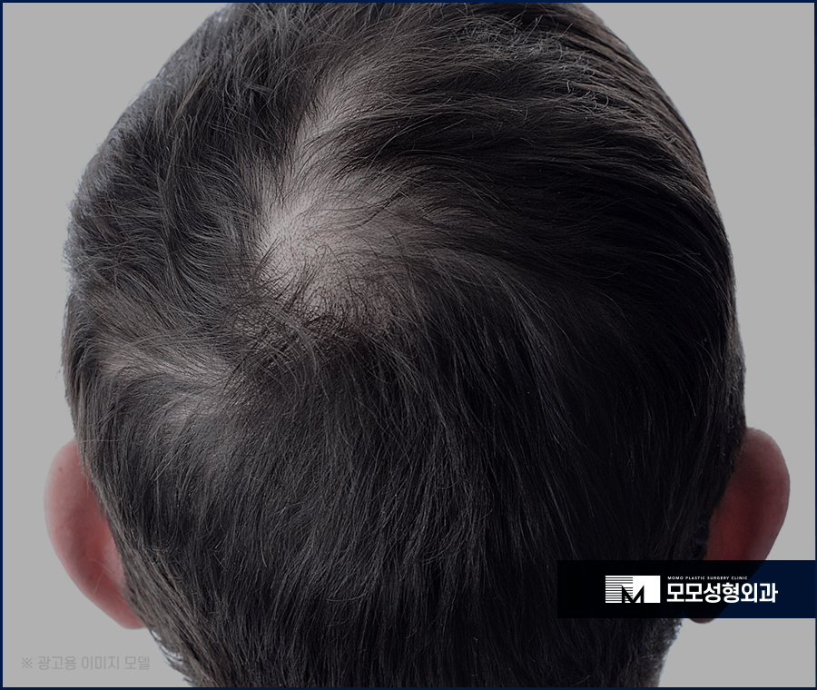 모발이식4000모 양보다 집중해야 하는 부분 관련 이미지 2