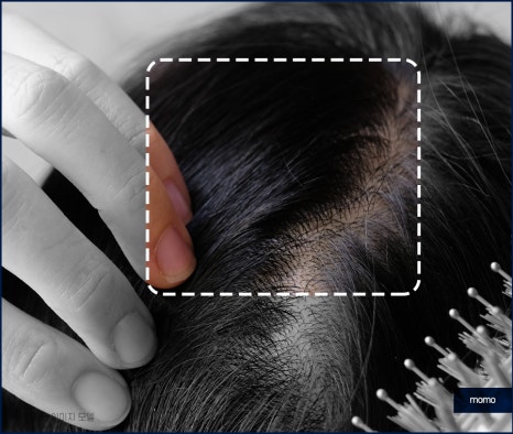 여성 모발이식 자연스러운 변화를 만드는 관련 이미지 5